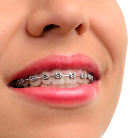 Invisalign - Pearl Align Braces