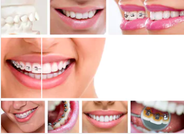 Stainless Steel Dental Orthodontic Braces at Rs 500/piece in Bengaluru